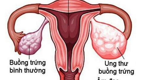 Ra máu bất thường có phải là dấu hiệu ung thư buồng trứng?