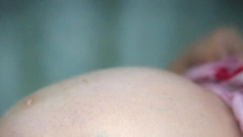 Bóc tách u xơ tử cung 12kg cho bệnh nhân 25 tuổi