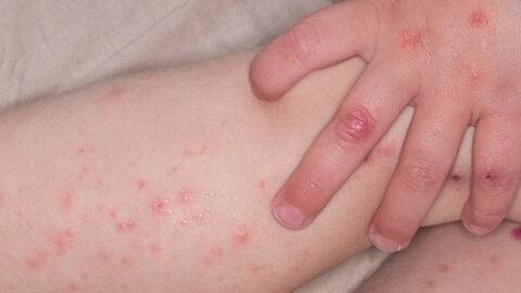 Số ca mắc tay chân miệng tiếp tục tăng