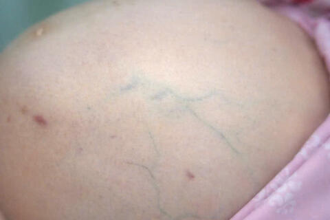 Bóc tách u xơ tử cung 12kg cho bệnh nhân 25 tuổi