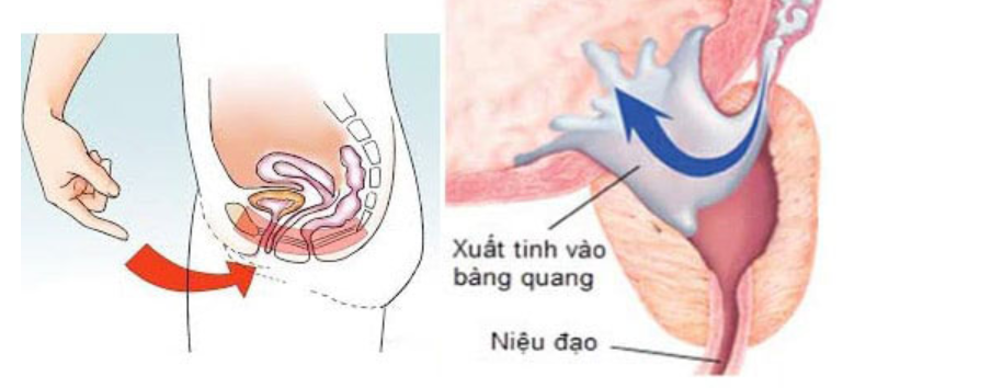 Nguyên nhân không ngờ khiến chàng trai trẻ mắc chứng “mất tích” tinh trùng, rối loạn cương dương  - Ảnh 4.