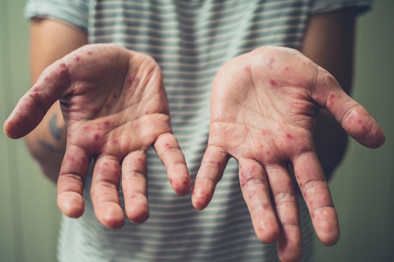 đỉnh dịch của bệnh đậu mùa khỉ ảnh 2 dinh dich cua benh dau mua khi anh 2