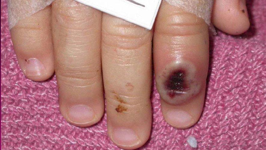 Phát hiện bệnh nhi nhiễm đậu mùa khỉ đầu tiên trên thế giới - Ảnh 1. Phát hiện bệnh nhi nhiễm đậu mùa khỉ đầu tiên trên thế giới - Ảnh 1.