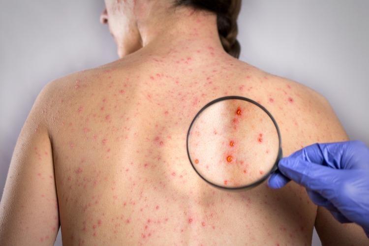 Dấu hiệu nhiễm bệnh và cách điều trị Rubella ảnh 1