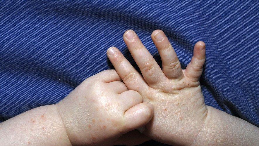 Bệnh đậu mùa khỉ ở trẻ em: Những điều cha mẹ cần biết về các nguy cơ và phòng ngừa - Ảnh 2. Bệnh đậu mùa khỉ ở trẻ em: Những điều cha mẹ cần biết về các nguy cơ và phòng ngừa - Ảnh 2.