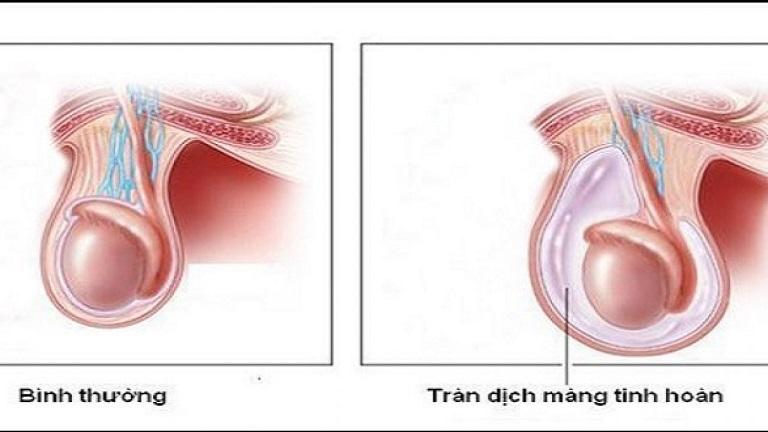 Căn bệnh hay gặp ở trẻ nhỏ dễ gây teo tinh hoàn, ảnh hưởng khả năng sinh sản - Ảnh 1.