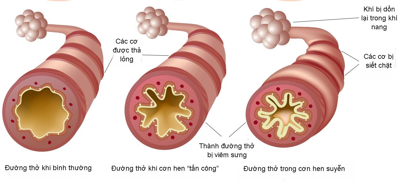 Cách sử dụng corticoid dự phòng hen suyễn cho trẻ - Ảnh 1.