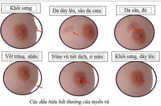 Bác sĩ cảnh báo về "điểm mù" trong kiểm tra ung thư vú tại nhà thường bị bỏ qua - Ảnh 4.