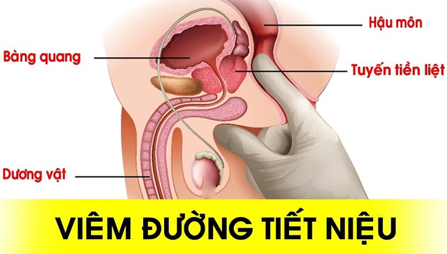 Phụ nữ viêm đường tiết niệu cần thay đổi 5 thói quen này nếu muốn bệnh nhanh khỏi - Ảnh 2.