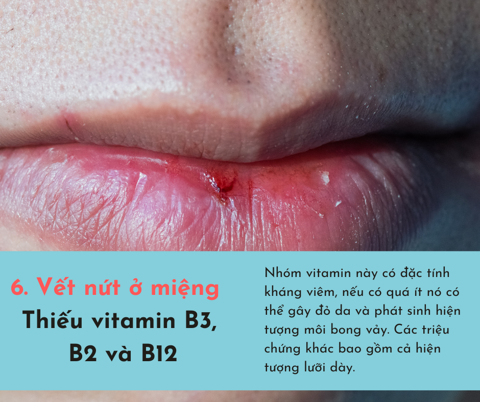 Cơ thể bị "cạn kiệt" vitamin sẽ phát ra 6 dấu hiệu, chủ quan bỏ qua có thể sẽ tổn thọ  - Ảnh 6.