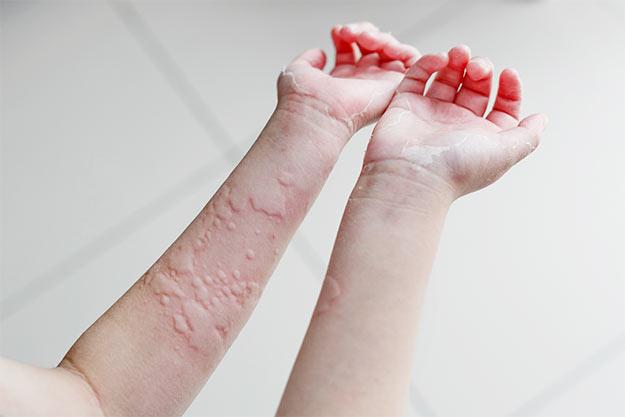 Acute-Urticaria.jpg