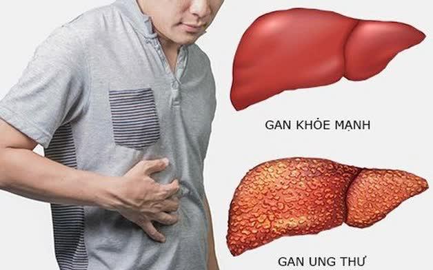 6 bệnh ung thư người Việt mắc phải nhiều nhất hiện nay - Ảnh 1.