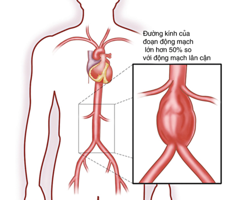 Bệnh hay gặp ở người cao tuổi, tăng huyết áp, xơ vữa mạch máu. Ảnh minh họa.