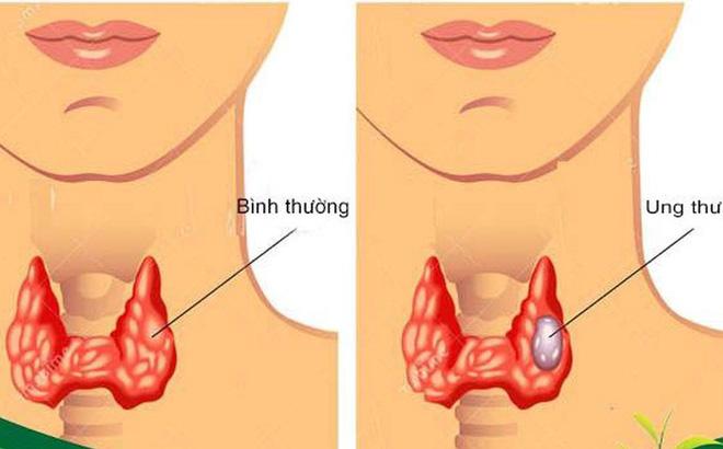 8 loại thực phẩm tốt cho người bệnh ung thư tuyến giáp - Ảnh 2.