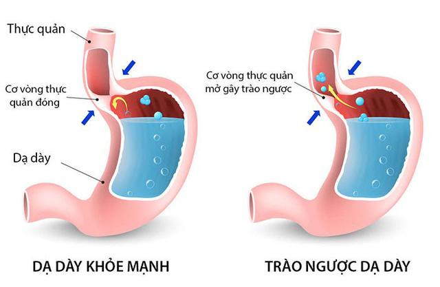 Bệnh trào ngược dạ dày thực quản có dẫn đến ung thư không? - Ảnh 1.