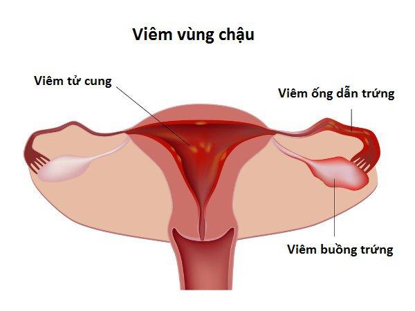 Bệnh lậu gây tổn hại đường sinh sản - Ảnh 4.