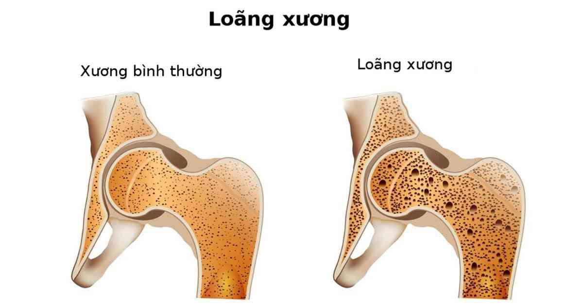 Loãng xương: 8 nhóm yếu tố nguy cơ bạn cần biết - Ảnh 1.