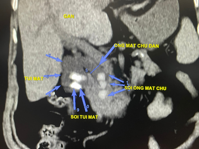 Cứu sống cụ bà 81 tuổi bị sốc nhiễm trùng đường mật trên nền thiếu máu nặng - Ảnh 1.