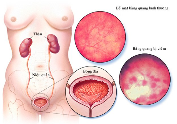 Đi vệ sinh thường xuyên, nóng rát: Nguy cơ viêm bộ phận này, nhiễm trùng có thể lan đến thận - Ảnh 2.