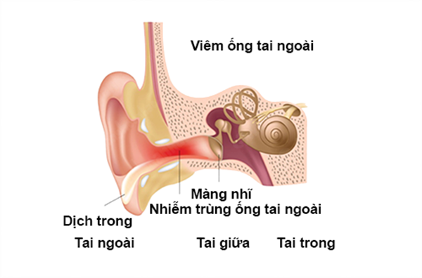 Trẻ đi bơi hay bị viêm ống tai - Nguyên nhân và cách khắc phục - Ảnh 1.