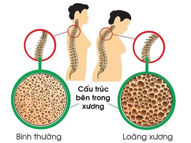 6 yếu tố gây nguy cơ loãng xương, ai cũng cần biết để phòng bệnh - Ảnh 3.