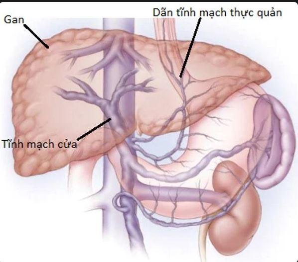 Bệnh nhân sốc mất máu do giãn vỡ tĩnh mạch thực quản bởi nguyên nhân gì? - Ảnh 1.