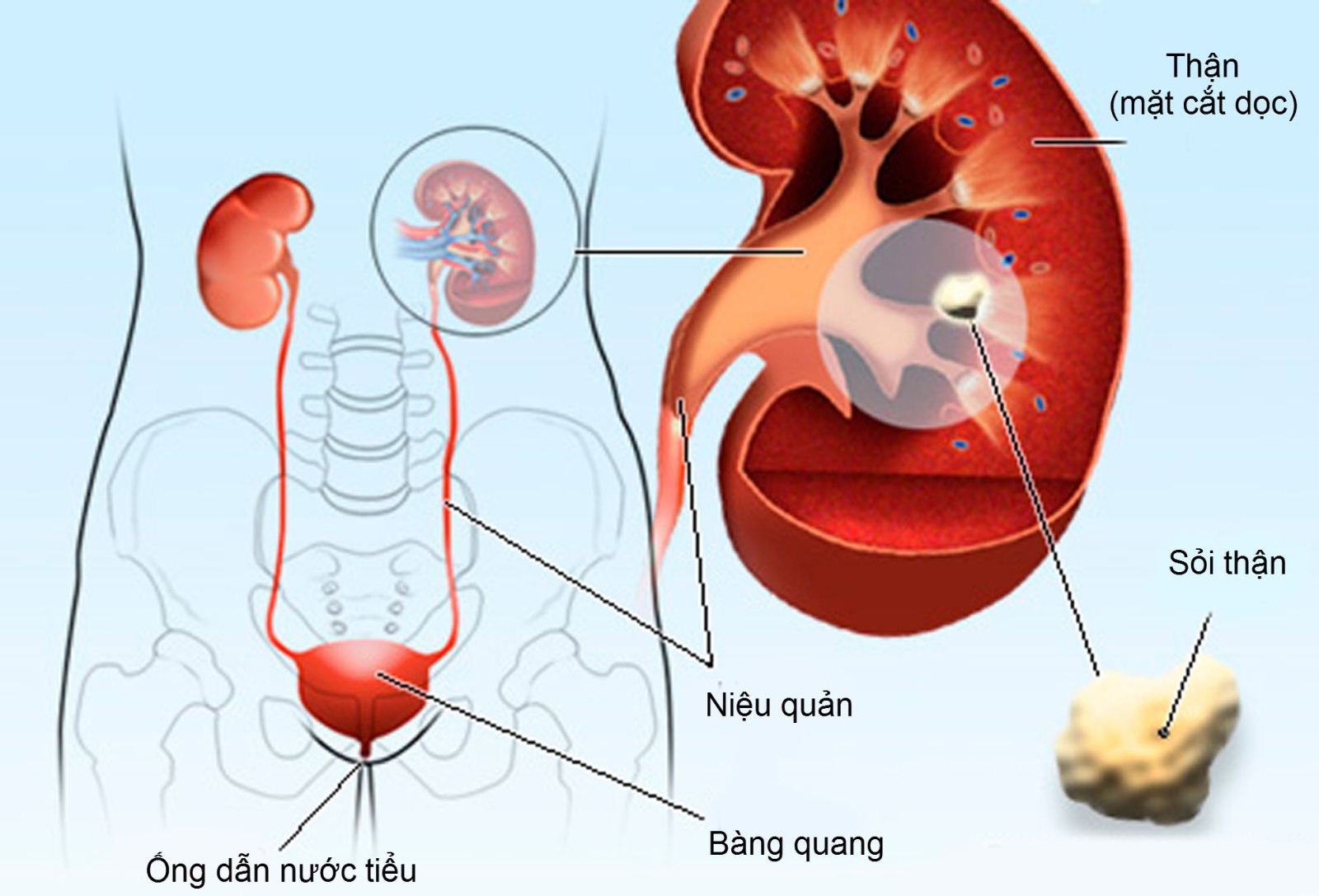 Người bị sỏi thận nên uống bao nhiêu nước mỗi ngày? - Ảnh 2.