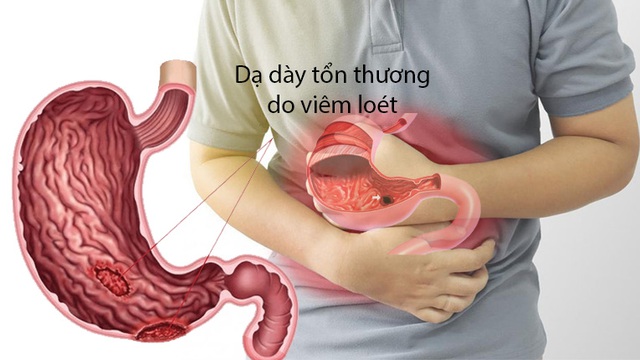 Ai bị đau dạ dày cần biết điều này, 5 thực phẩm nên ăn để phòng các cơn đau tái phát - Ảnh 2.