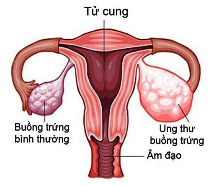 Ra máu có phải là dấu hiệu ung thư buồng trứng? - Ảnh 2.