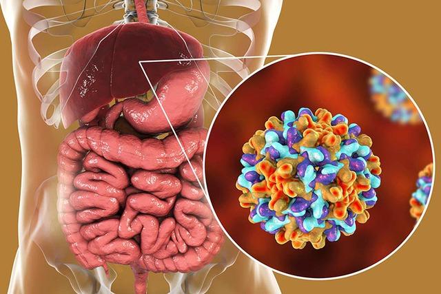 Người đàn ông 42 người bị ung thư gan do mắc sai lầm này, ai có dấu hiệu bệnh này cần được khám càng sớm càng tốt - Ảnh 2.