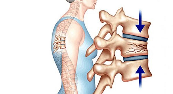 Nữ bệnh nhân bị gãy đốt sống vì chủ quan với bệnh xương khớp, đây là dấu hiệu ngầm cảnh báo bệnh! - Ảnh 4.