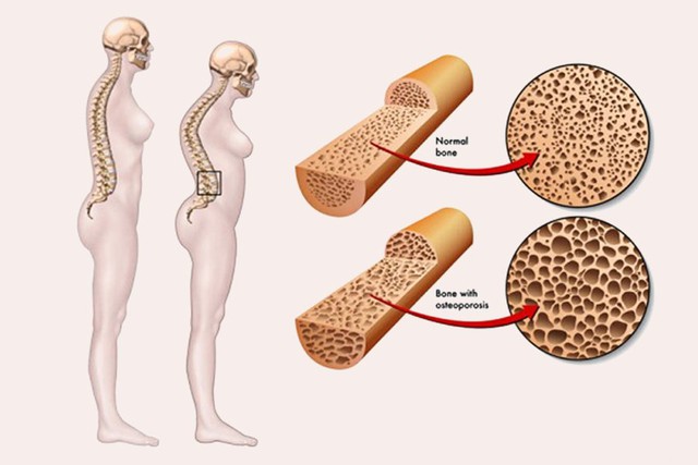 Nữ bệnh nhân bị gãy đốt sống vì chủ quan với bệnh xương khớp, đây là dấu hiệu ngầm cảnh báo bệnh! - Ảnh 3.