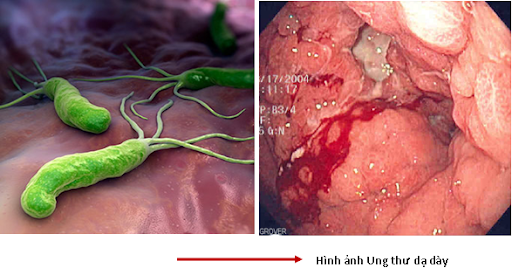 Cảnh giác với 5 nguyên nhân gây ung thư dạ dày, đây là 7 dấu hiệu điển hình cần được khám sớm! - Ảnh 3.