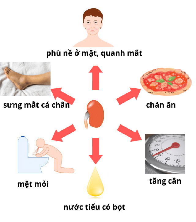 Thanh niên 20 tuổi bất ngờ phát hiện mắc hội chứng thận hư dù không có triệu chứng, đây là biến chứng đáng sợ nếu không điều trị đúng cách! - Ảnh 4.