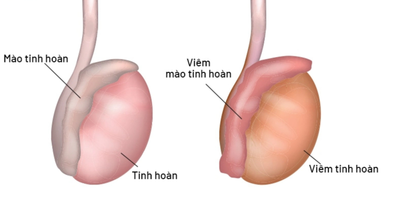 8 nguyên nhân phổ biến gây đau tinh hoàn- Ảnh 2.