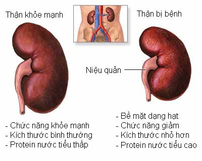 9 triệu chứng khi mắc bệnh thận, suy thận ai cũng cần biết- Ảnh 1.