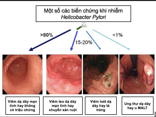 HP gây ung thư dạ dày, những điều cần biết về vi khuẩn này- Ảnh 2.