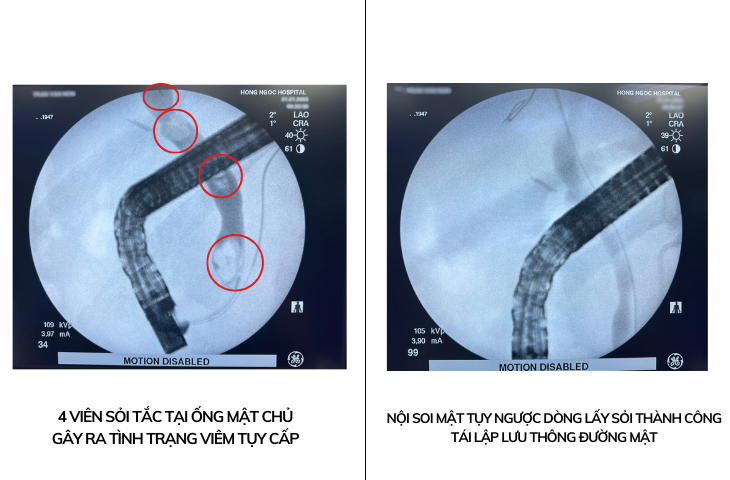 Tình trạng ống mật chủ của bệnh nhân trước và sau khi được nội soi mật tụy ngược dòng lấy sỏi