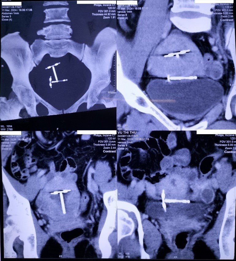 Hình ảnh siêu âm ổ bụng bệnh nhân cho thấy hình ảnh vòng tránh thai trên màn hình.
