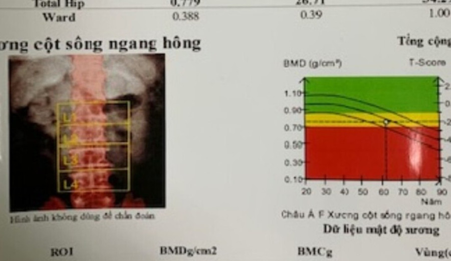 Kết quả đo loãng xương bằng phương pháp DEXA của một bệnh nhân bị biến chứng loãng xương do tự ý dùng corticoid kéo dài. Ảnh: BVCC