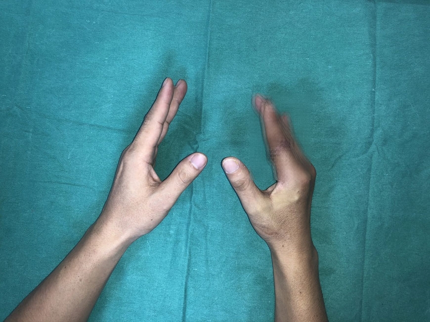 Lần đầu tiên tại Việt Nam: Vi phẫu thuật thành công cứu sống ngón tay thủy thủ bị đứt rời sau 25 giờ