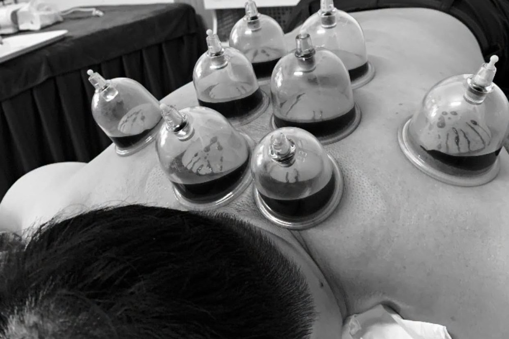 Điểm chung của các phương pháp này là dựa trên cách lý giải về “máu độc”, “huyết ứ”, “máu tắc nghẽn” và cho rằng việc lấy máu ra ngoài sẽ giúp lưu thông khí huyết. Tuy nhiên, đây không phải cơ chế điều trị đột quỵ được y khoa hiện đại công nhận. Ảnh: FBNV 812167167-1065359026100572-3575487529058764860-n-9543.jpg